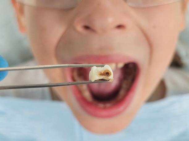 Best Chipped Tooth Repair Near Me  in Navy, VA